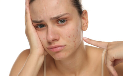 Dlaczego kwas salicylowy to niezawodna pomoc przy trądziku?